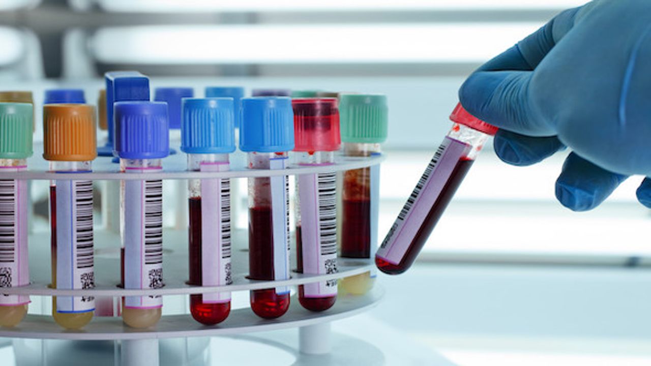İngiltere'de 50'den fazla kanser türünü erken tespit etmesi umulan kan testi denenecek