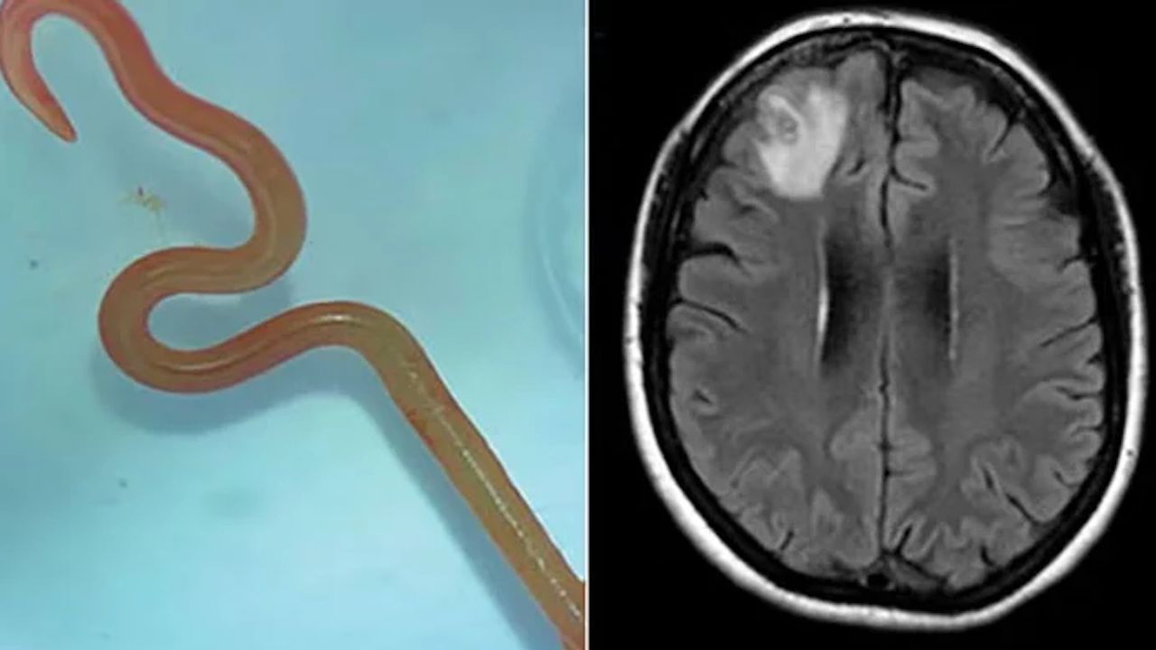 Avustralya'da bir kadının beyninden canlı solucan çıkarıldı